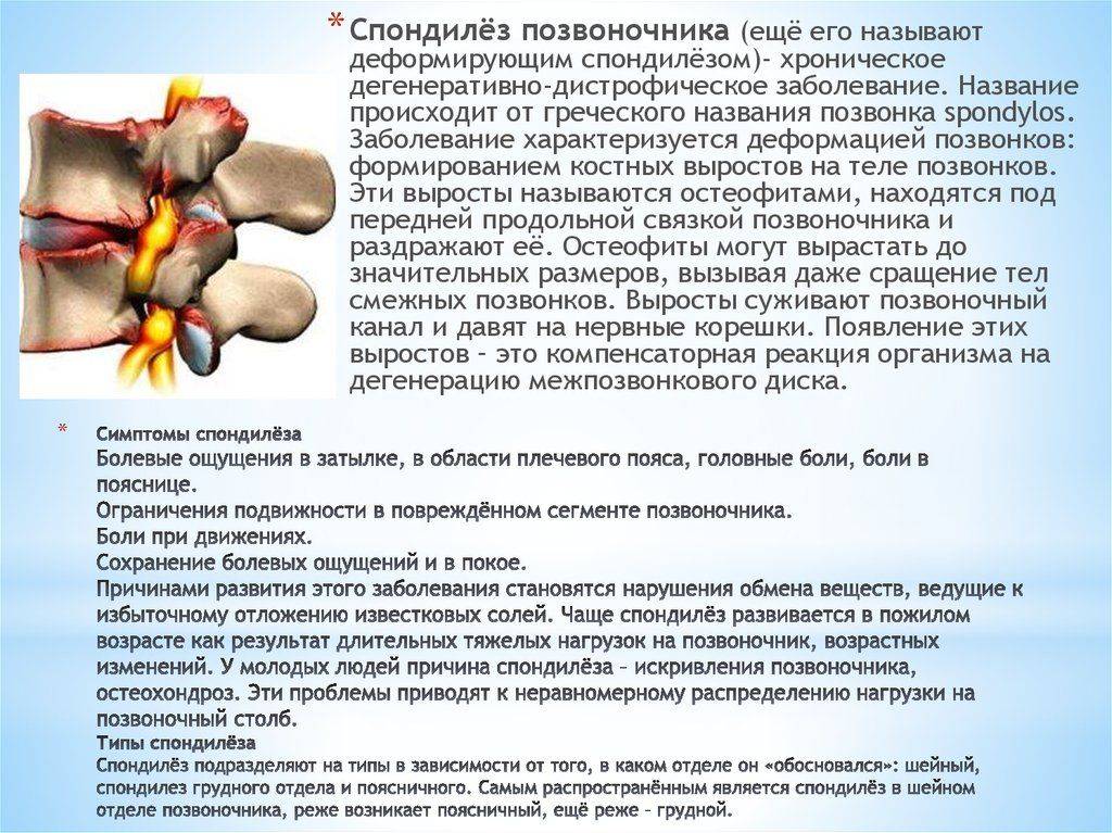 Спондилёз