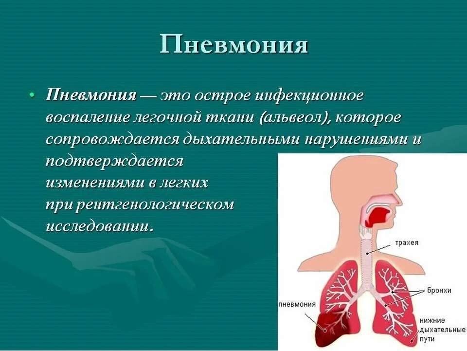 Картинки на тему пневмония