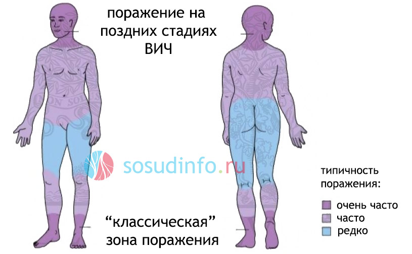 Ангиосаркома кожи как выглядит