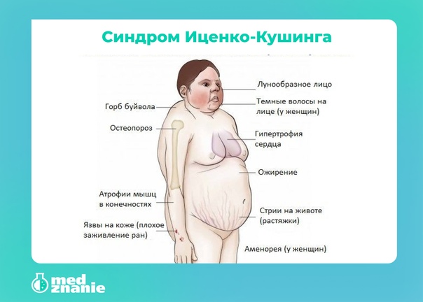 Вторичный гиперкортицизм или болезнь иценко-кушинга