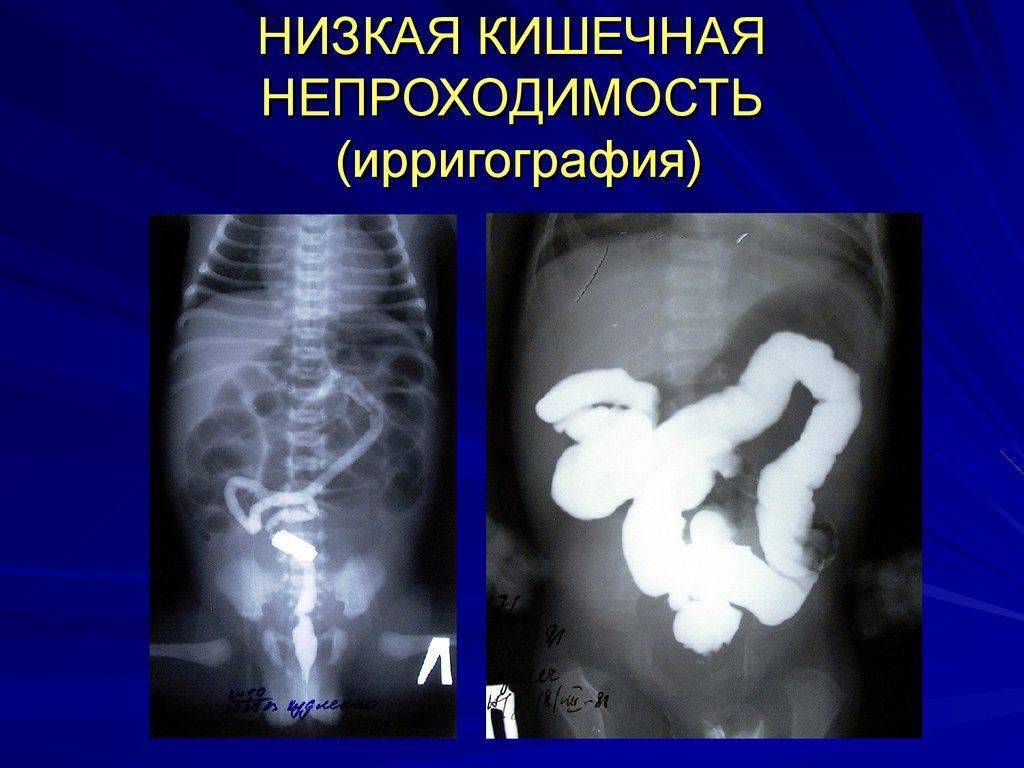 Кафедра факультетской хирургии пспбгму. острая кишечная непроходимость. часть 3.