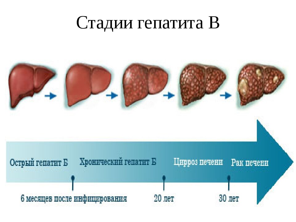 Последняя стадия цирроза печени
