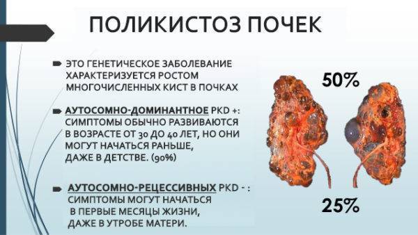 Поликистоз почек * клиника диана в санкт-петербурге