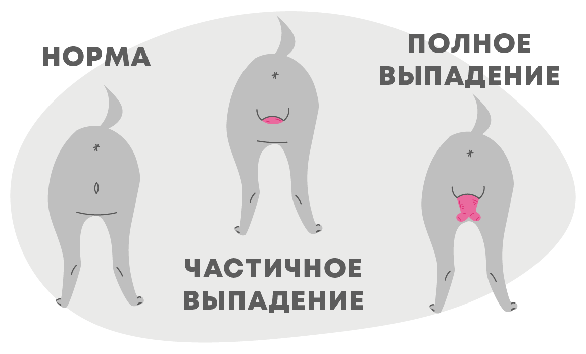 Опущение и выпадение матки: объяснение гинеколога