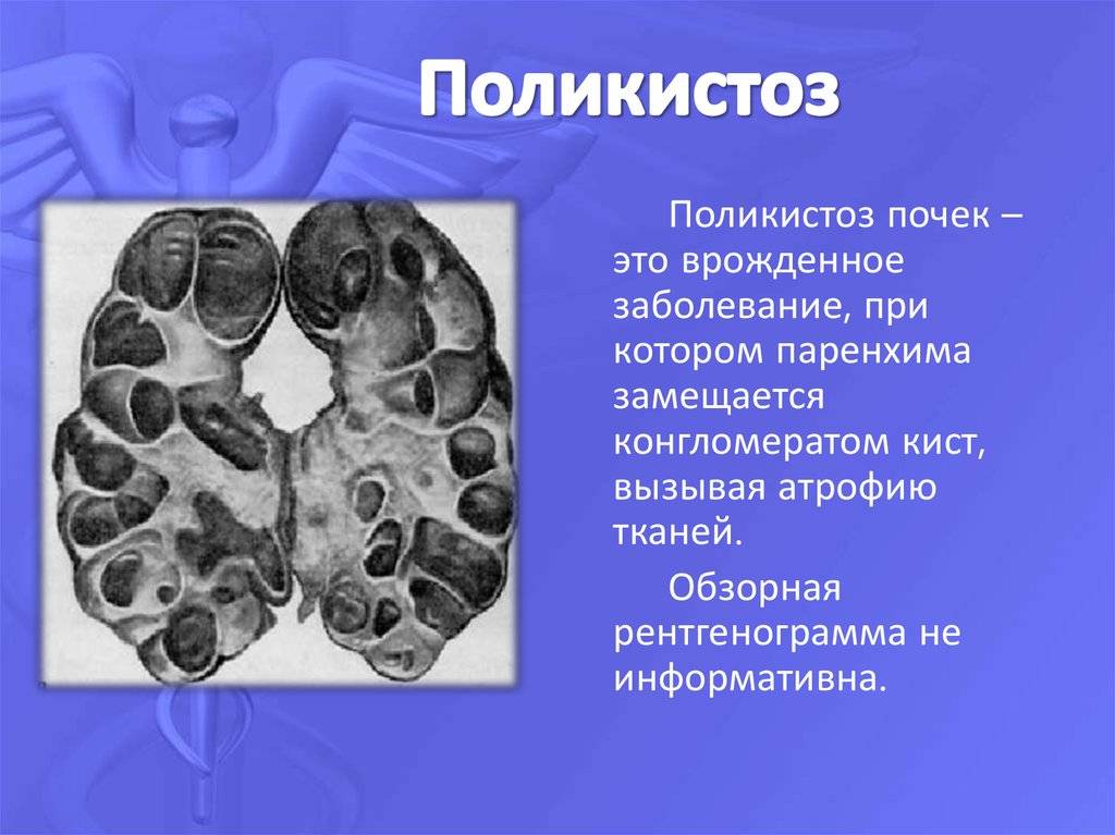 Поликистоз почек у кошек и котов