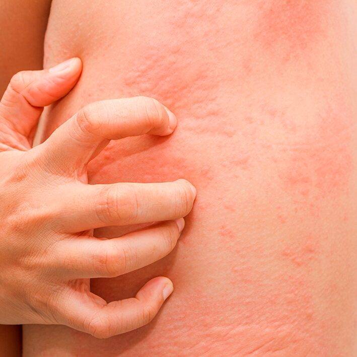 Бывает ли аллергия на хомяков?