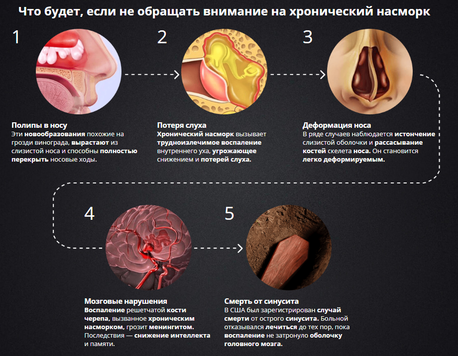 Как лечить заложенность носа при насморке?