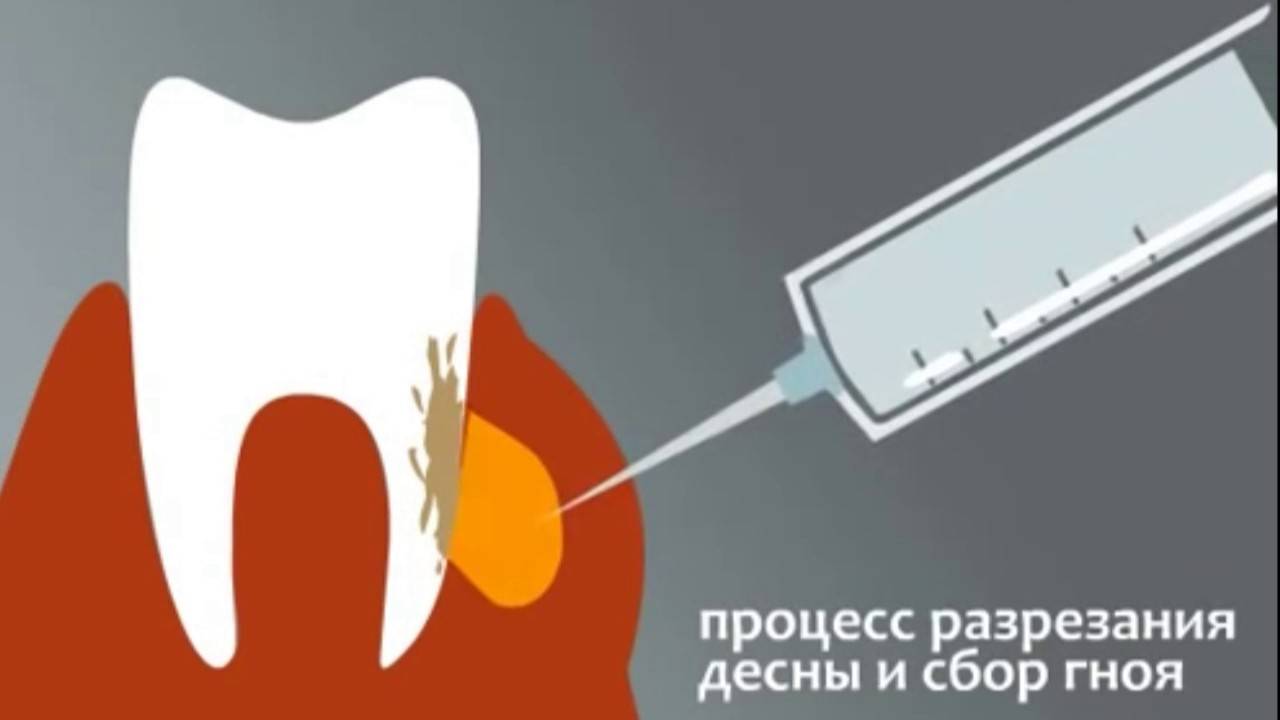 Флюс: что это такое и как лечить - стоматология дентко