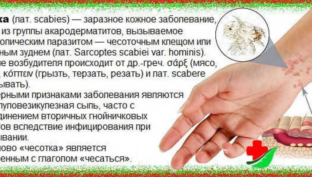 аскаридоз аллергические реакции