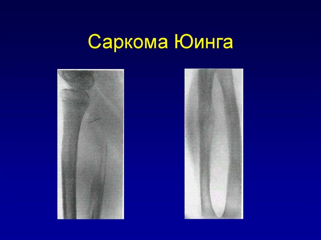 Саркома юинга - симптомы болезни, профилактика и лечение саркомы юинга, причины заболевания и его диагностика на eurolab