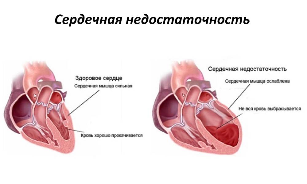 Лечение сердечной недостаточности. медикаментозное и хирургическое лечение сердечной недостаточности.!