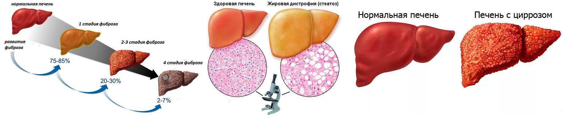 Цирроз печени / заболевания / клиника эксперт