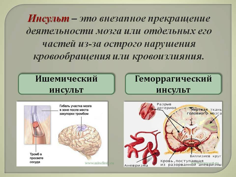 Диагностика инсульта на кт