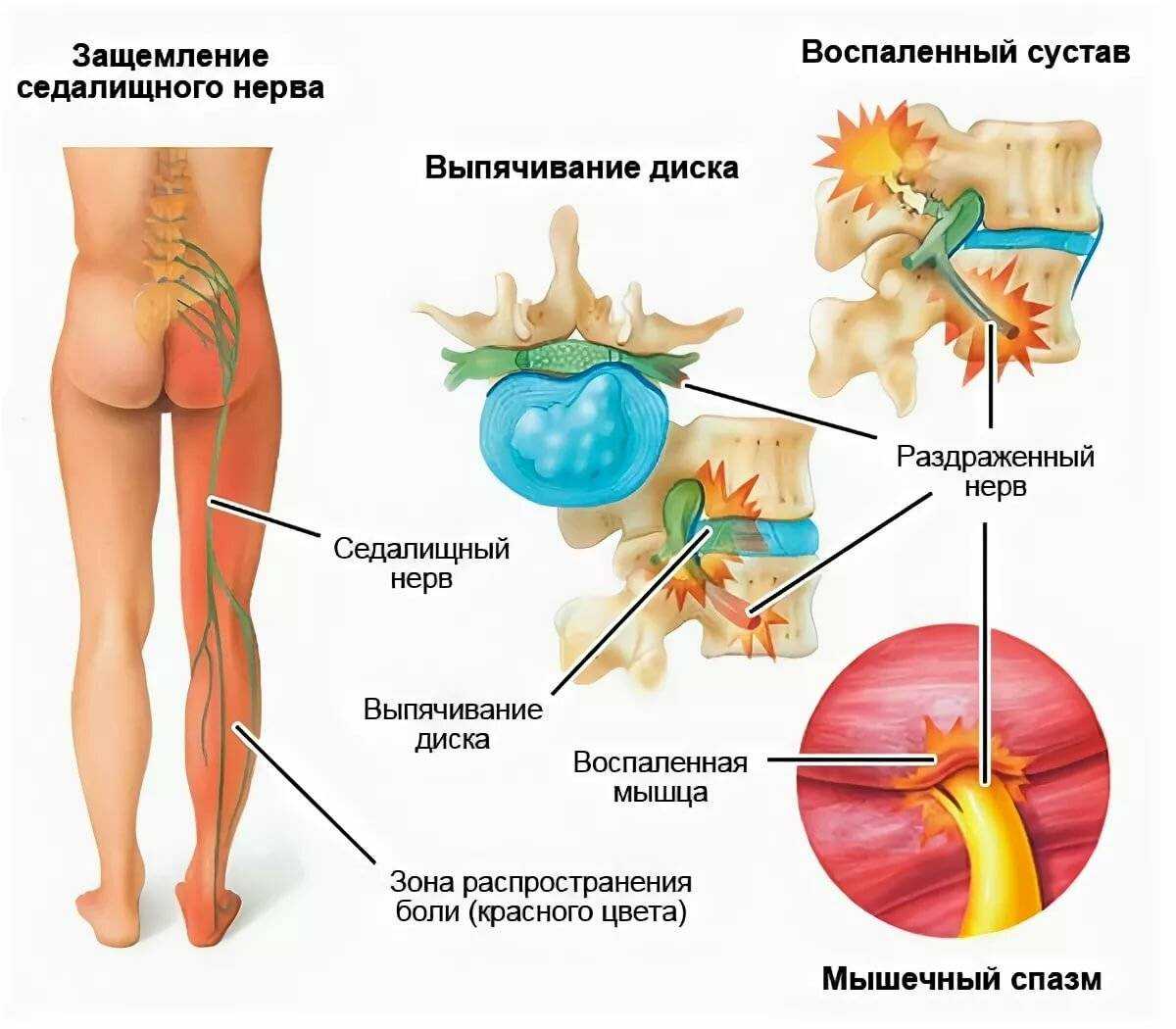 выбор матраса при грыже поясничного отдела позвоночника