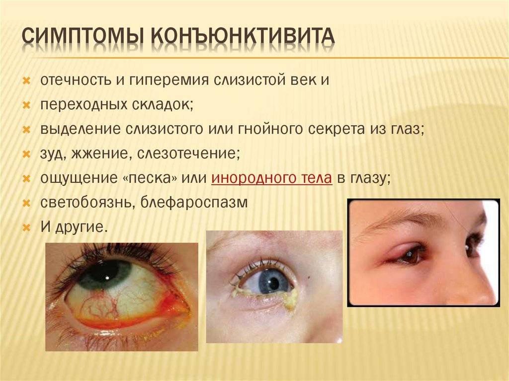 5 способов отличить вирусный конъюнктивит от бактериального