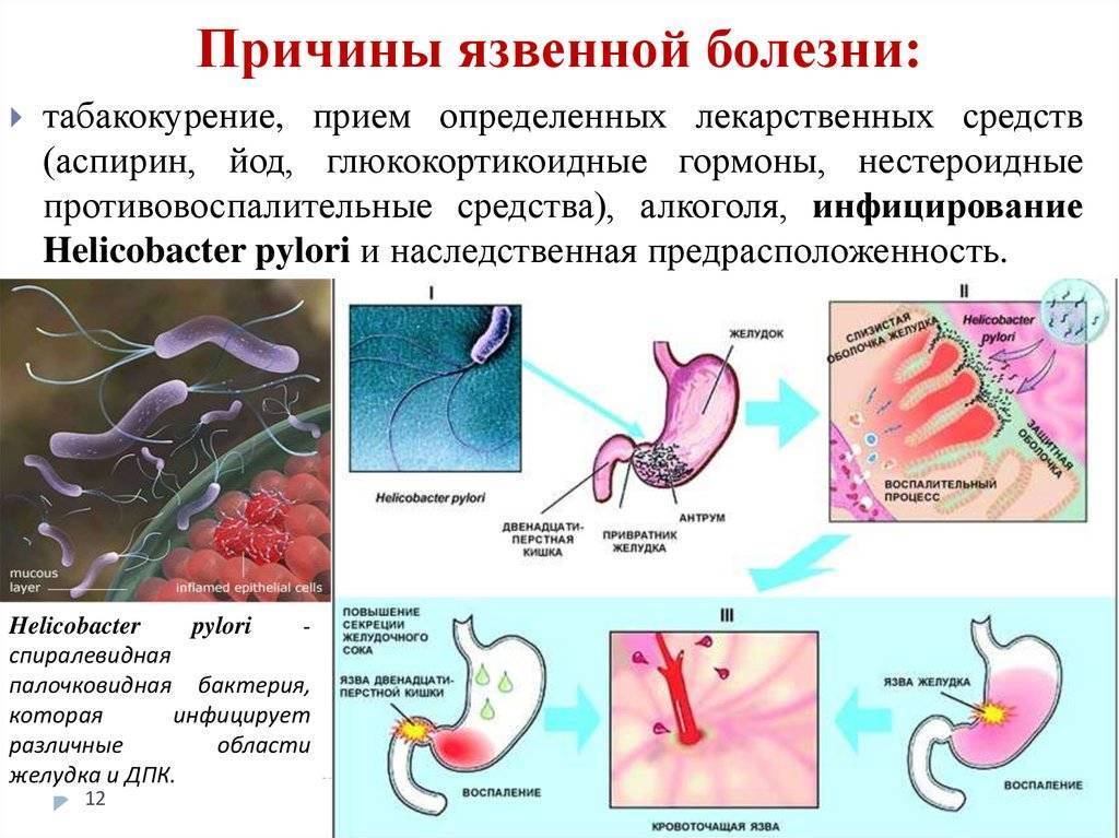 Язвенная болезнь желудка и двенадцатиперстной кишки: виды, симптомы, диагностика и лечение