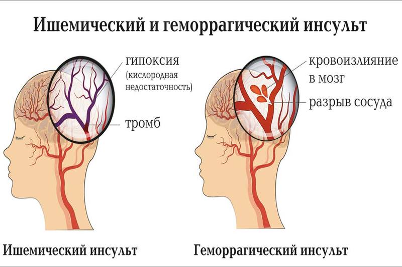 Инсульт у собаки: симптомы и лечение, прогнозы, питание и восстановление в домашних условиях, как проявляется микроинсульт, чем лечить, препараты