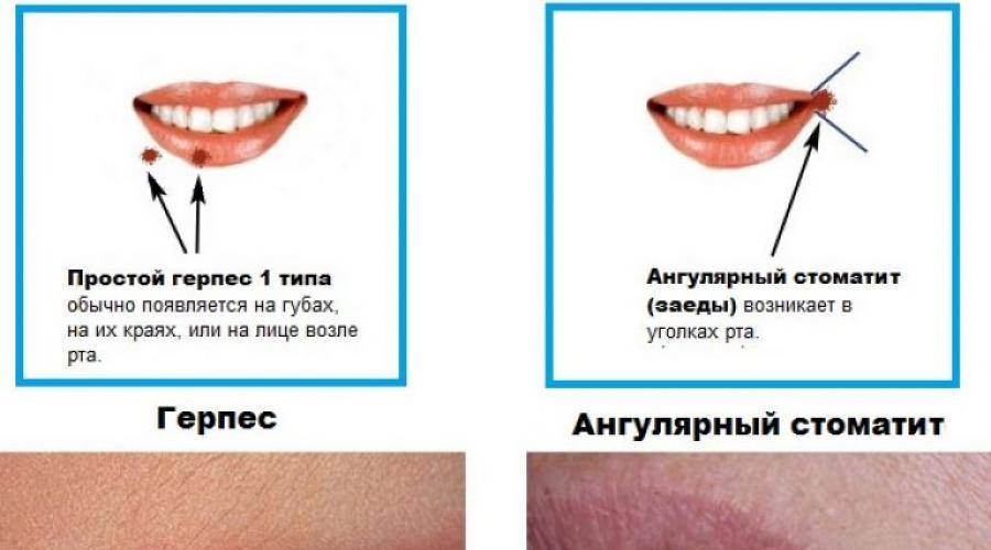 Язвы в полости рта – клинические признаки при различных заболеваниях