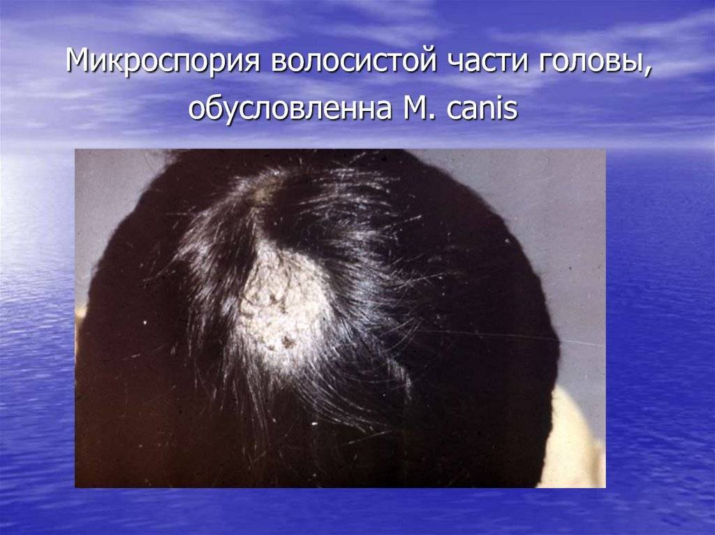 Микроспория (стригущий лишай) кожи и ногтей у детей и взрослых - возбудители инфекции, пути заражения, симптомы, лечение и профилактика, фото