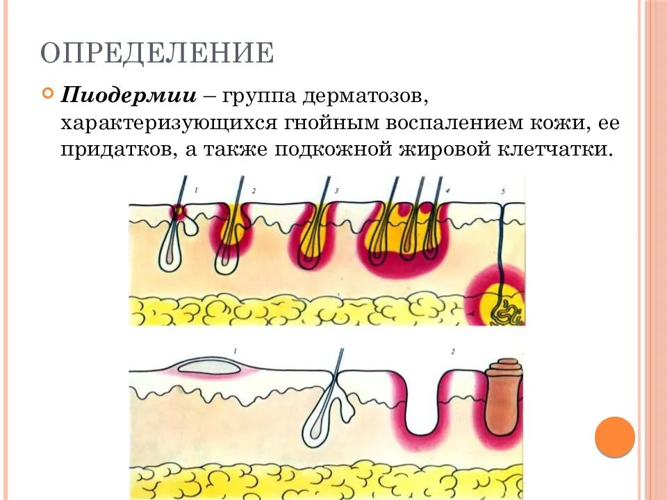 Лечение различных форм пиодермии у детей и взрослых