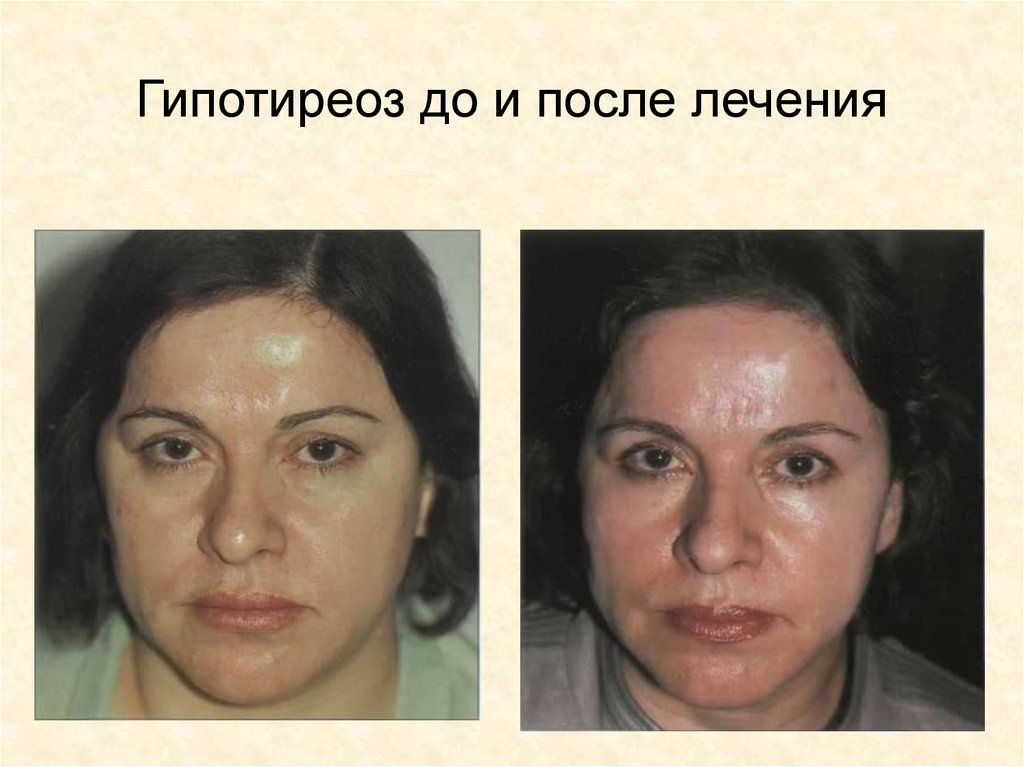 Гипотиреоз у собак: причины и как лечить