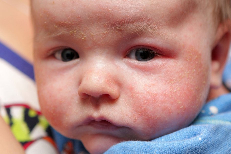 Аллергический дерматит у грудного ребенка: кто виноват и что делать?