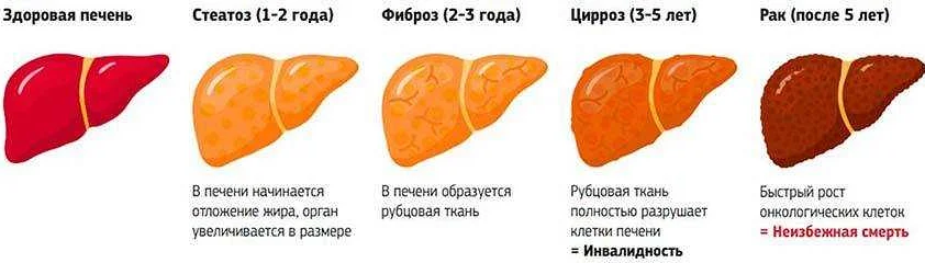 Фиброз печени картинки