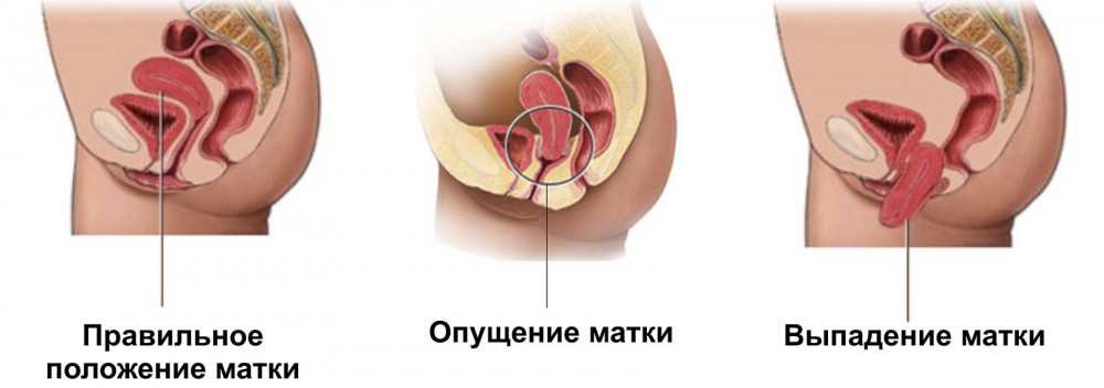 Опущение матки — что делать, если поставлен такой диагноз?