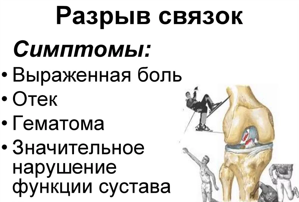 Повреждение связок тазобедренного сустава. Перерастяжение связок тазобедренного сустава симптомы.