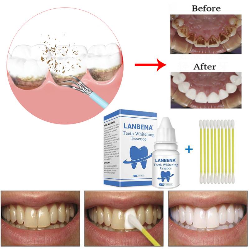 Лазерная чистка зубов | стоматология митино