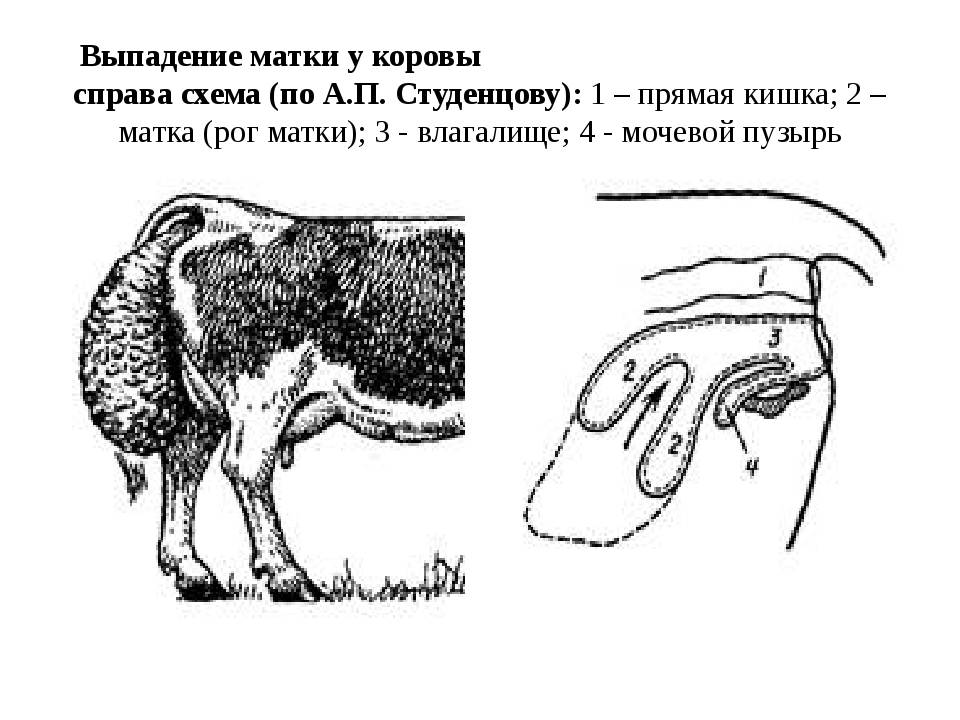 Опущение стенок влагалища и матки: безоперационное и хирургическое лечение | frau klinik - клиника пластической хирургии и косметологии