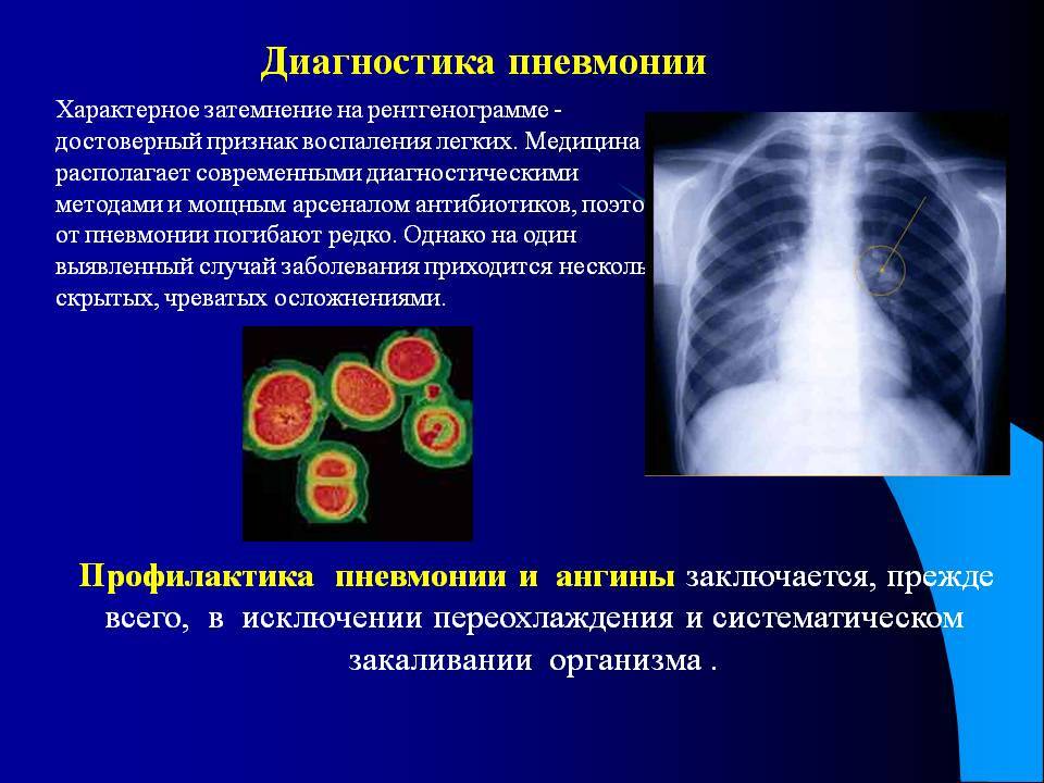 Вирусная пневмония