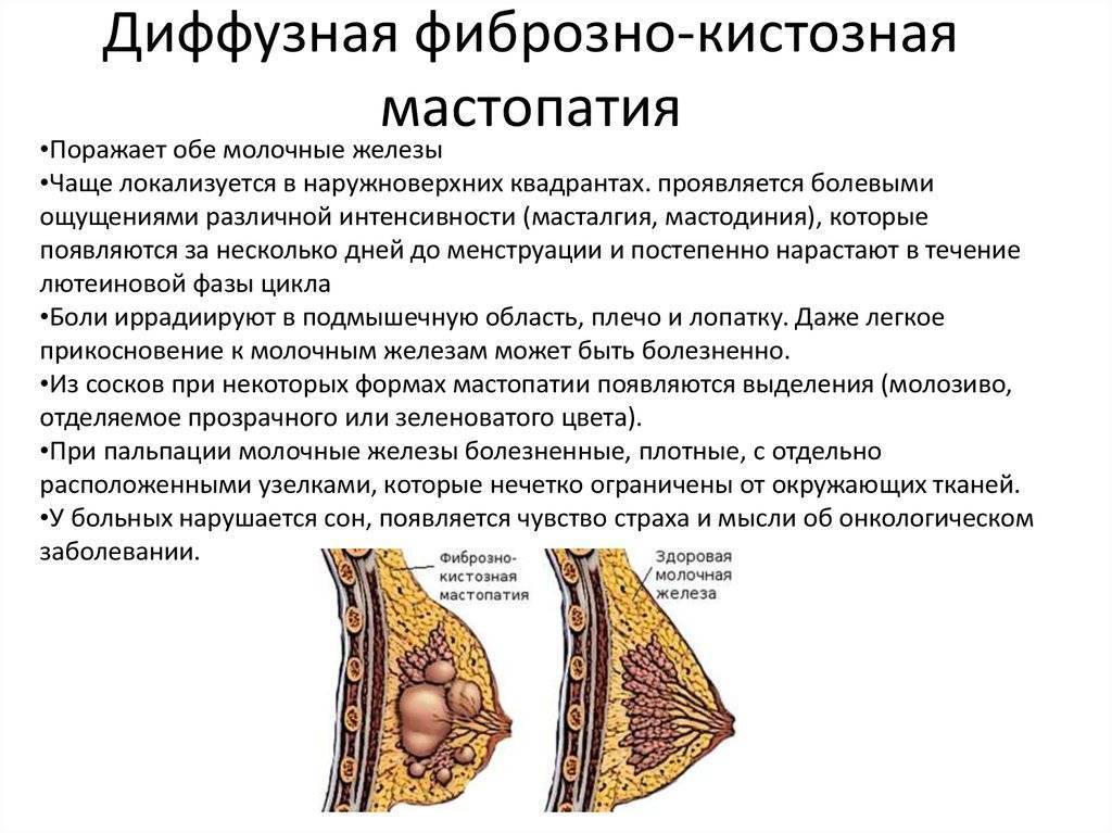 Мастопатия и беременность: что делать, симптомы и лечение | маммологический центр