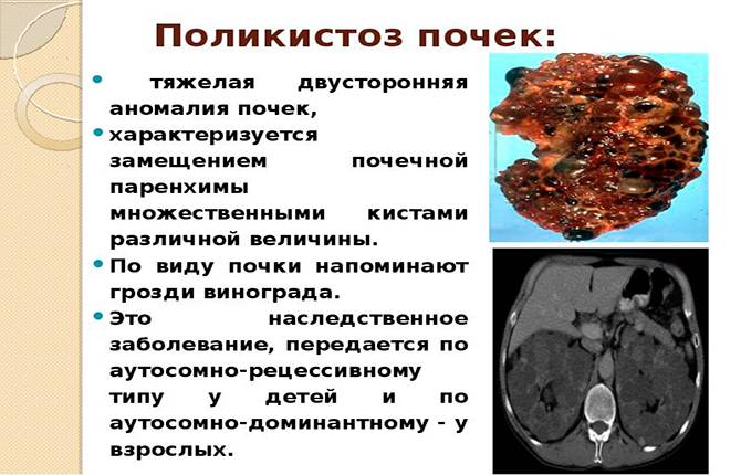 Поликистоз. симптомы, причины и лечение поликистоза печени.