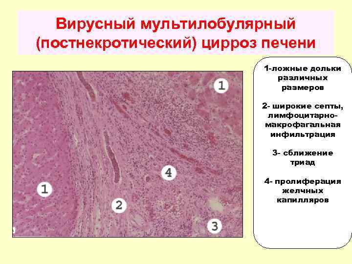Папилломы у мужчин