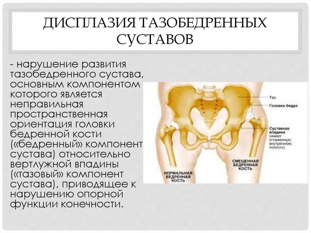 Дисплазия, что это такое: лечение и симптомы, степени и виды дисплазии, диспластический синдром | клиники «евроонко»