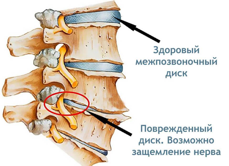 Лечение острых травм спинного мозга: переломов и вывихов — центр ветеринарной неврологии и нейрохирургии