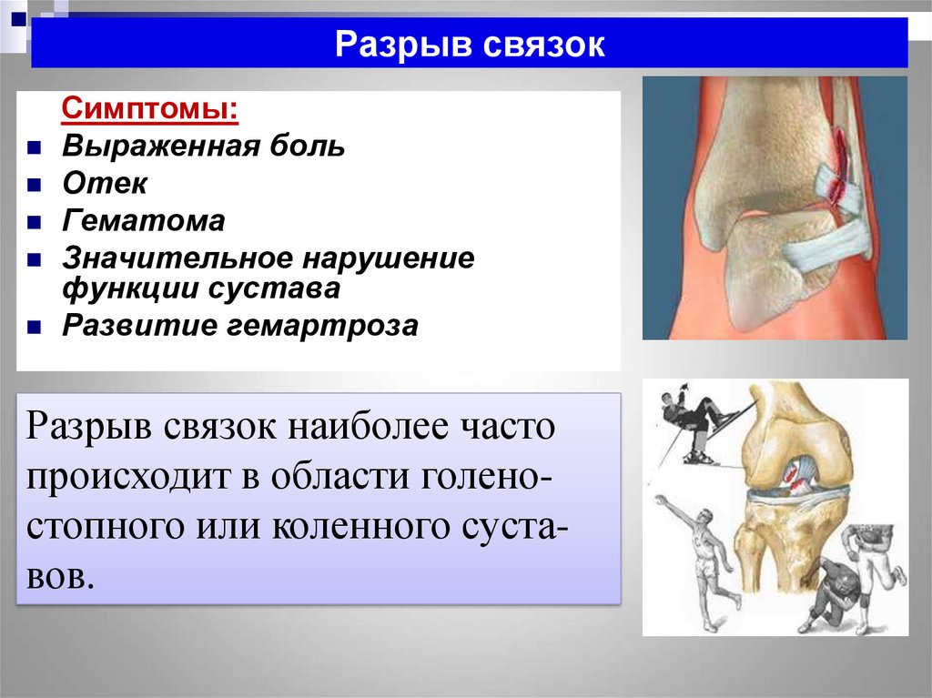 Рисунок разрыв связок