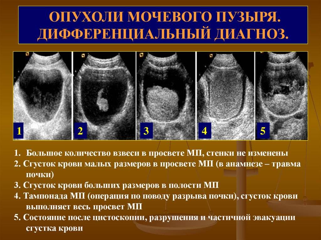 Рак железы: фото, диагноз, признаки и симптомы рака груди на разных стадиях рмж.